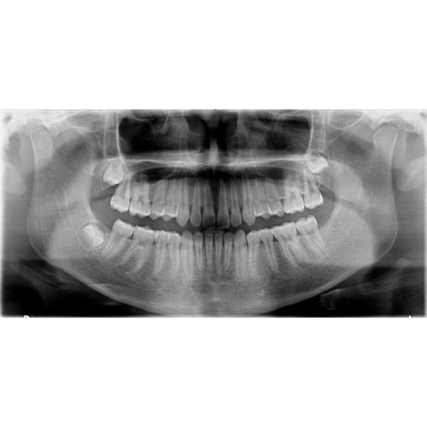 CARESTREAM CS 9000C 3D PANOREX + CEPH + CONE BEAM