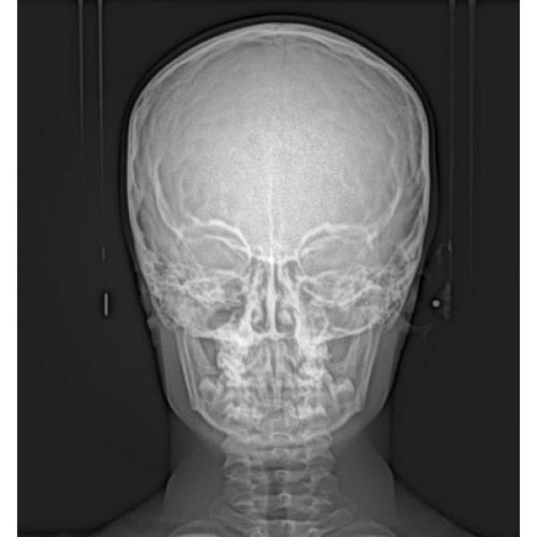 CARESTREAM CS 9000C 3D PANOREX + CEPH + CONE BEAM