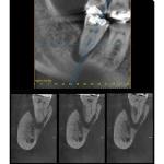INSTRUMENTARIUM OP300 PANOREX + CONE BEAM