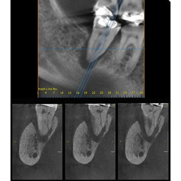 INSTRUMENTARIUM OP300 PANOREX + CONE BEAM