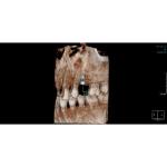 INSTRUMENTARIUM OP300 PANOREX + CONE BEAM