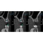 INSTRUMENTARIUM OP300 PANOREX + CONE BEAM