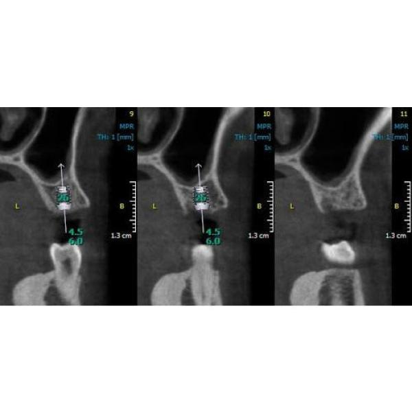 INSTRUMENTARIUM OP300 PANOREX + CONE BEAM