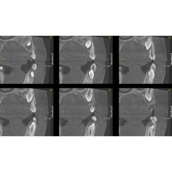 INSTRUMENTARIUM OP300 PANOREX + CONE BEAM