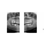 INSTRUMENTARIUM OP300 PANOREX + CONE BEAM