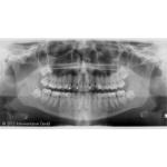 INSTRUMENTARIUM OP300 PANOREX + CONE BEAM