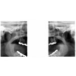 INSTRUMENTARIUM OP300 PANOREX + CONE BEAM